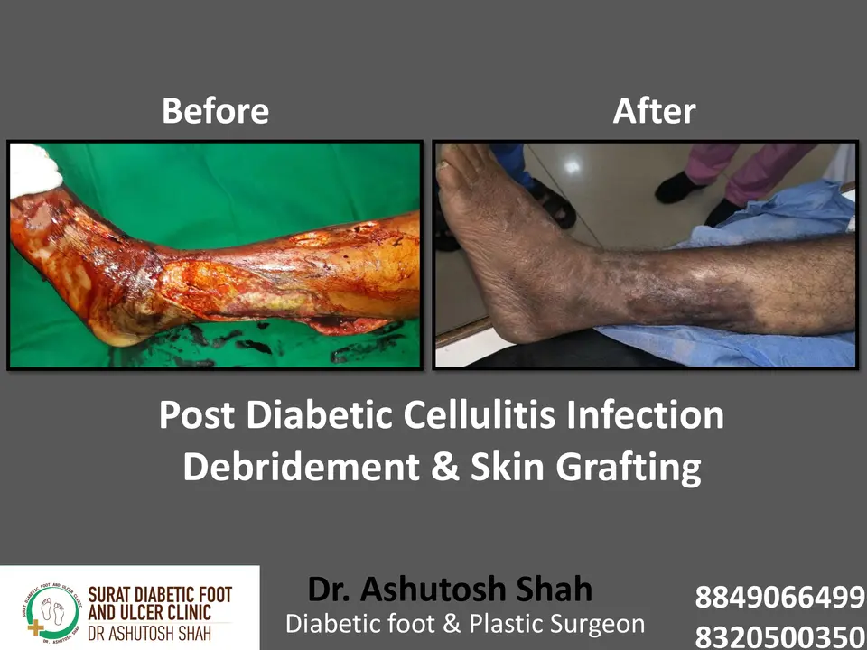 Diabetic Cellulitis and Coverage.pptx-8.webp